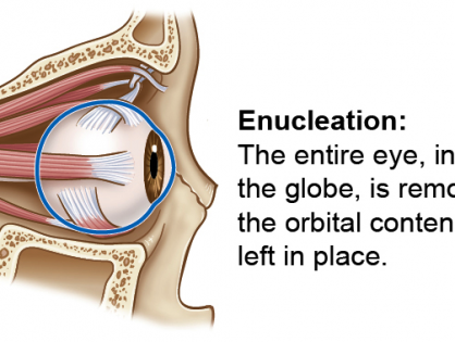 Enucleation