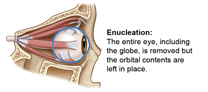 Enucleation