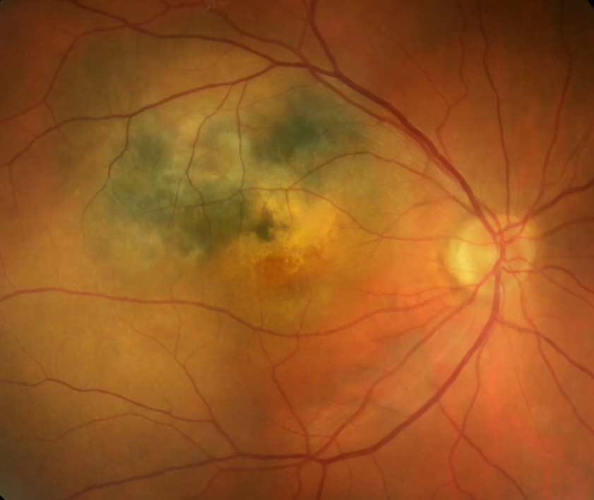 Choroidal Melanoma