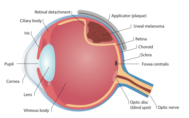 CTOOS-choroidal-melanoma